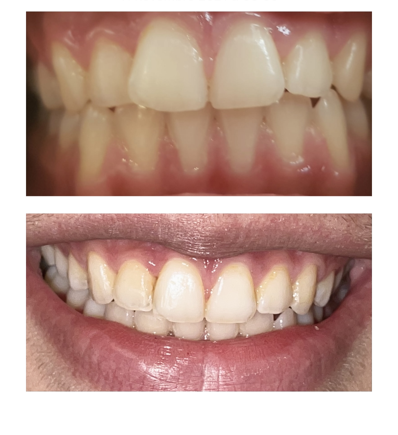 مرتب کردن دندانها با الاینر