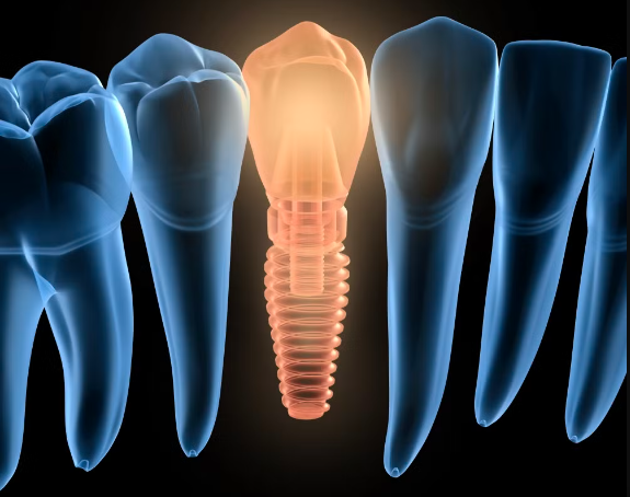 ایمپلنت های دندانی